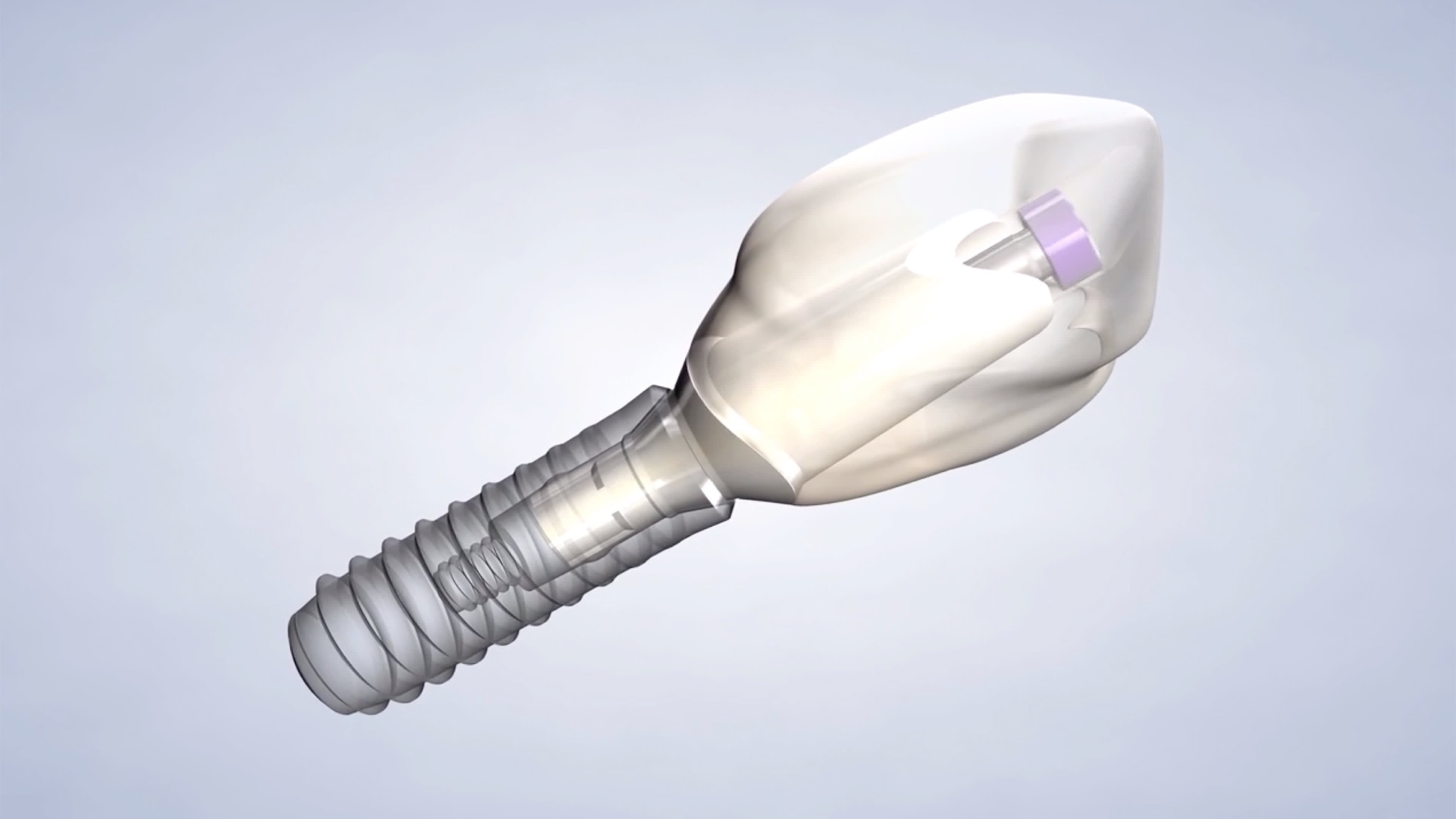 Illustration of a dental implant | Mount Pleasant, SC