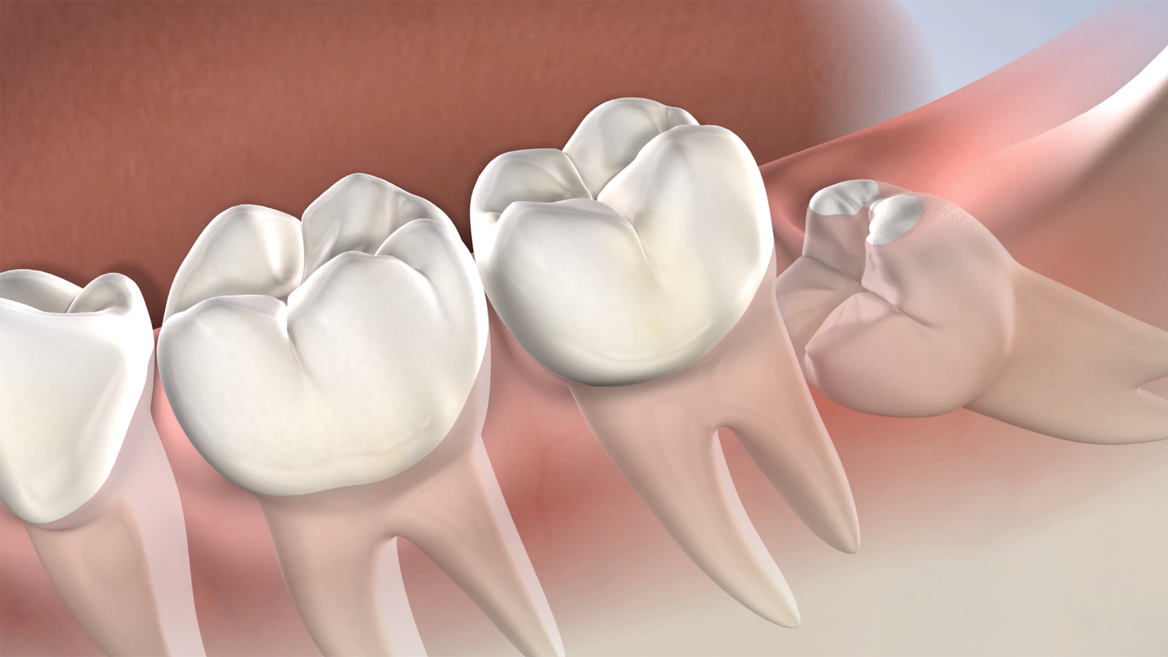 Illustration of impacted wisdom teeth
