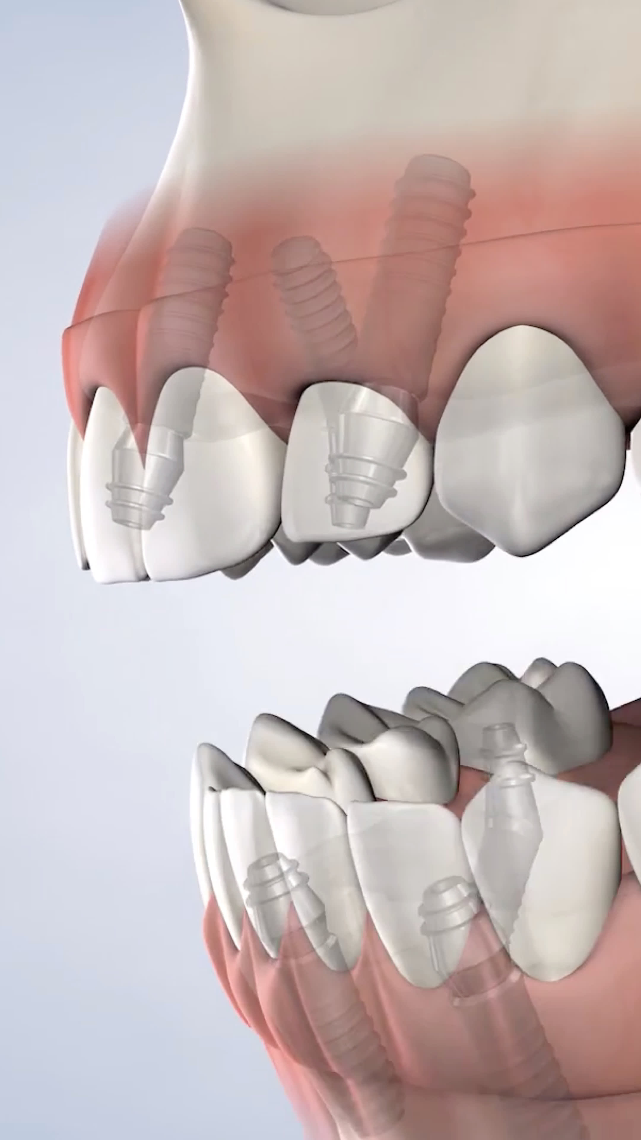 Illustration of full-arch restoration