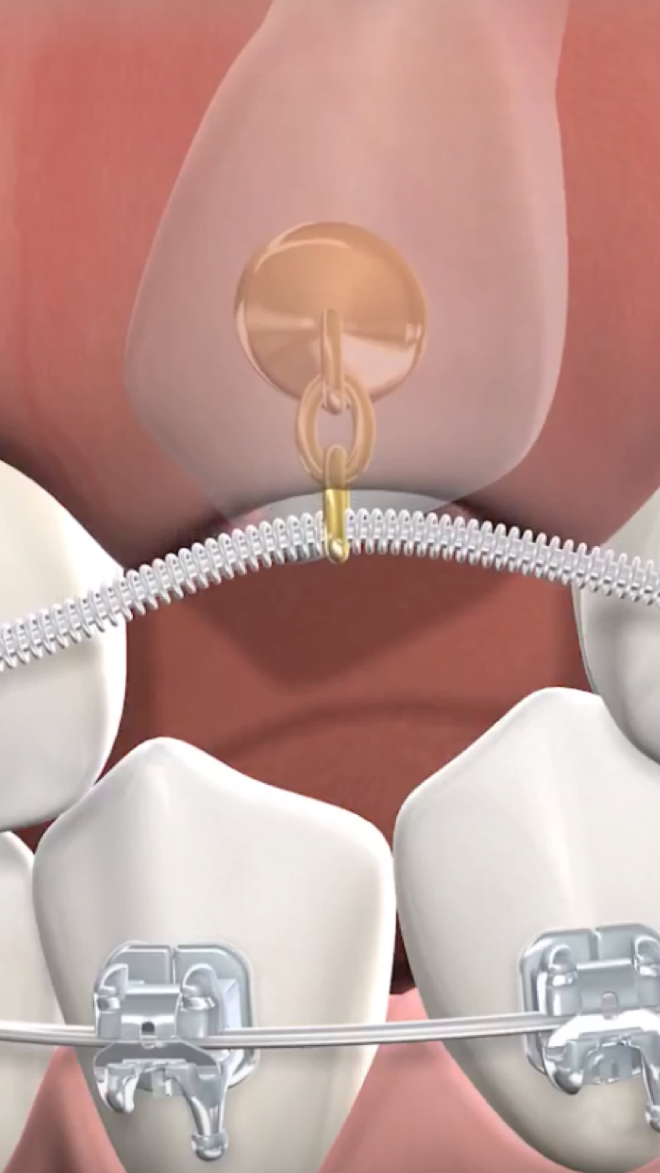 Illustration of impacted canines